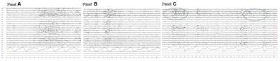 Case report: Childhood epilepsy and borderline intellectual functioning hiding an AADC deficiency disorder associated with compound heterozygous DDC gene pathogenic variants